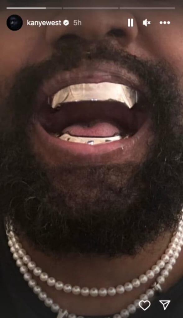 Kanye West titanium dentures